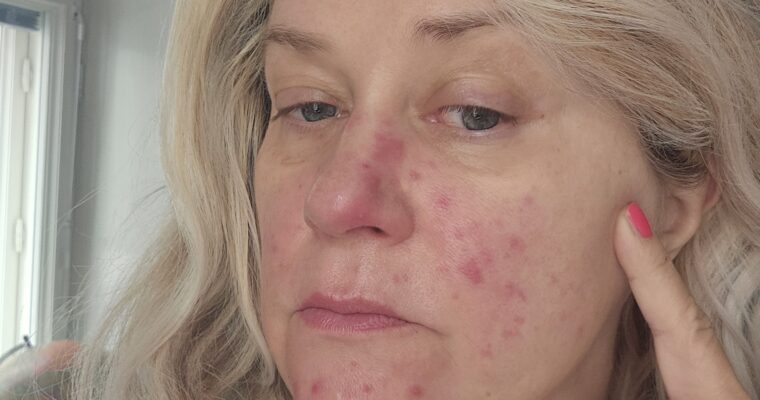 IhoPro hoiti ruusufinnin kuntoon!